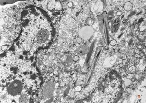 bone marrow - crystalloid inclusions Charcot-Leyden crystals formation